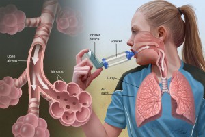 Góc giải đáp: Trẻ em bị bệnh hen suyễn có chữa khỏi được không?